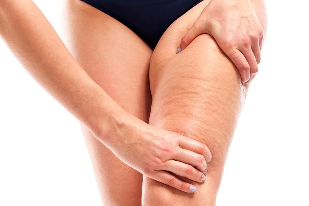 ¡Descubre nuestros tratamientos para eliminar la celulitis!