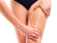 ¡Descubre nuestros tratamientos para eliminar la celulitis!